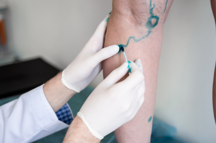 Escleroterapia Convencional