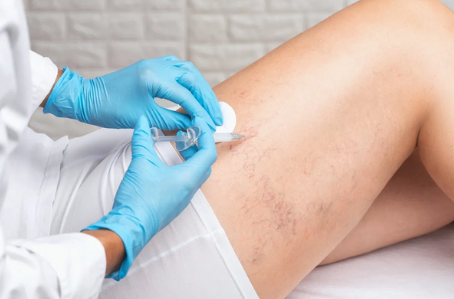 Escleroterapia com Espuma